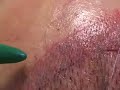 Hair transplant dallas:recipient site creation,male hairline