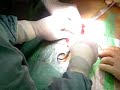 Aneurisma aortico #01: Isolamento arterie femorali