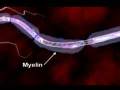 What is Multiple Sclerosis - YouTube
