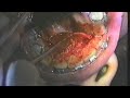 Maxillary Lingual Corticotomy Pt 3-A