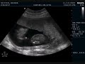 Baby Vetter