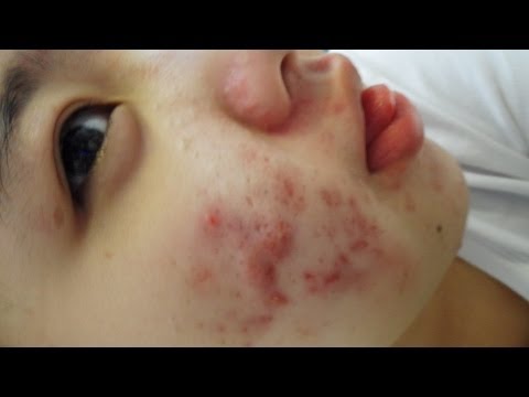 My Acne Story: Pre - Accutane