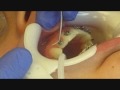 Orthodontist Places Braces on Patient--See how easy it is to get braces.