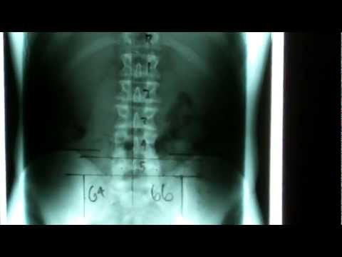 how to measure cervical curve on x-ray