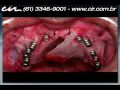 Hospital Cir Premier Protocolo superior é o nome dado a técnica que substitui todos dentes na arcada superior através de implantes dentários. O implante dental é um pequeno cilindro confeccionado em titânio puro, com roscas externas semelhante a um parafuso. O titânio adere ao tecido ósseo, produzindo uma ligação biológica entre o osso eo titânio, conhecida como osseointegração.