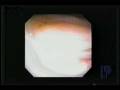 videos de Parker Intubation thru the Vocal Cords