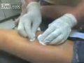 Woman has cyst drained at doctor's office