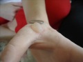 Worlds Biggest Blister!! Worlds Biggest Blister!!