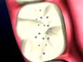 Tooth decay