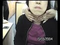 Goiter minimization under Thyroid Throu - Case2 before