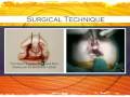 Noordhoff Craniofacial Foundation: Operation Syllabus for Bilateral Cleft Lip and Palate