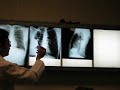 ABSCESO PULMONAR CON PARED CALCIFICADA ABSCESO PULMONAR CON PARED CALCIFICADA