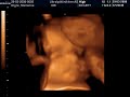 3D Ultrasound of Jacob - 9