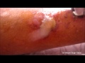 Draining A Pustule