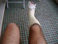 Gambaletto resina x distorsione caviglia