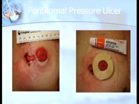 how to provide ostomy care