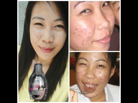 how to take clindamycin 300 mg for acne