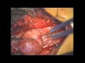 Lumbar Intradural Tumor