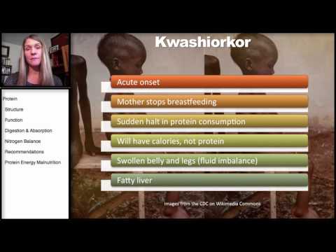 how to treat kwashiorkor and marasmus