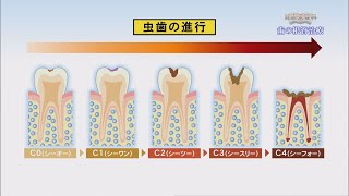 第50回歯の根管治療