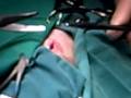 videos de Ankle Surgery Screw Removal
