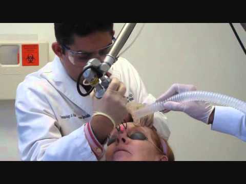 Fractional CO2 Laser Resurfacing for Wrinkles