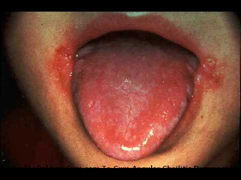 how to treat glossitis