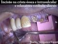 Cirurgia de Implante Protocolo Superior com Carga Imediata - Periodonto.Net