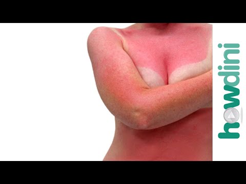 how to cure sunburn face