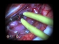Neurosurgery Case - AVM