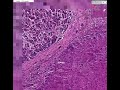 Histopathology Liver--Hepatocellular carcinoma in cirrhosis Cirrhosis