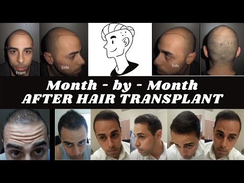 how to hair transplant in india