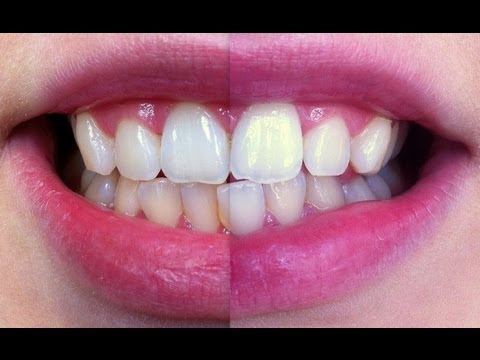 how to quickly whiten your teeth at home
