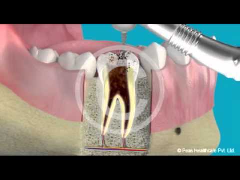 how to treat perforation in rct