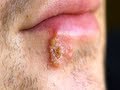 What is HSV-1? (Beauty & Grooming Guru)