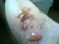 My mates gammy leg thing!!!! yuk!!! My mates gammy leg thing!!!! yuk!!!