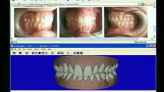 Прозрачные пластиковые каппы.