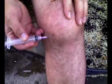 how to drain a knee of fluid
