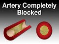 Consequences of Cholesterol (Cholesterol #2)