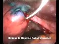 Laparoscopic proximal salpingoplasty