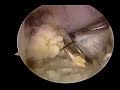 Anterior Cruciate Ligament Reconstruction (Allograft)