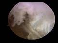 Anterior Cruciate... View Video