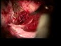Tympanoplasty