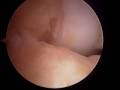 ZR Dr. Vangsness ACL surgery Part 1