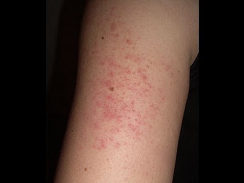 how to remove kp bumps