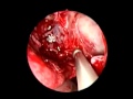 Lateral Sphenoid Meningocele