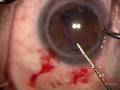 videos de Malyugin ring placement (please view my other video)
