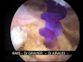 suture coiffe sous arthroscopie suture coiffe sous arthroscopie