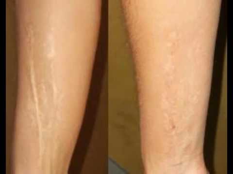 how to get rid scar on legs