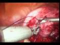 Laparoscopic Myomectomy, extracorporeal continous